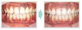 審美歯科の治療例について